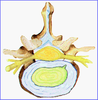 Hernia de disco, protusion discal